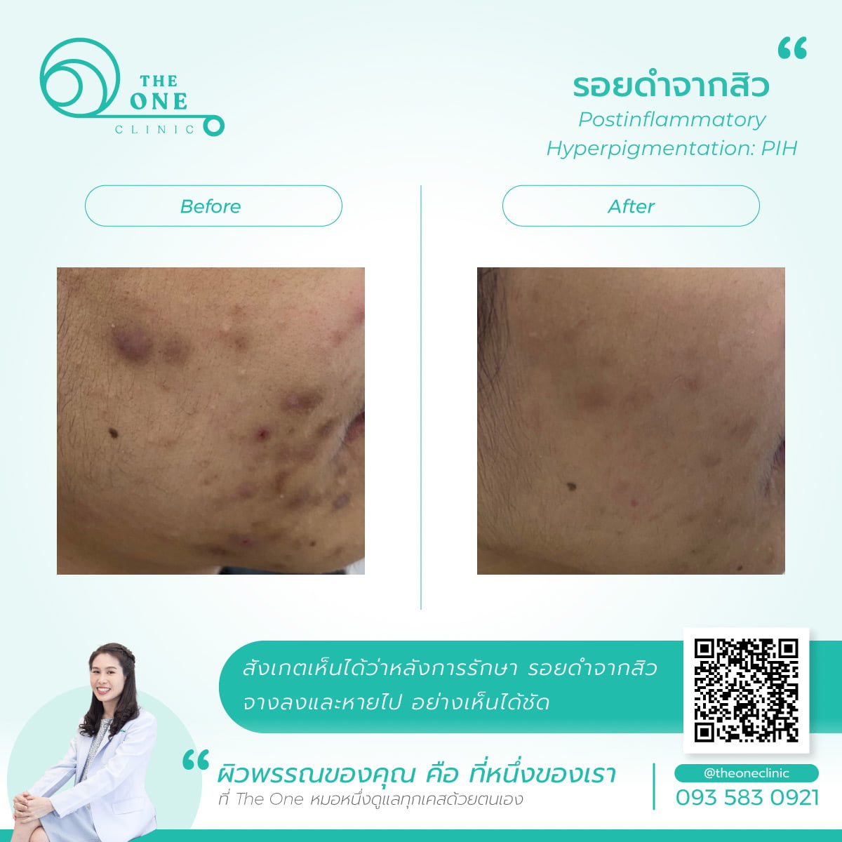 รีวิวรักษารอยดำ