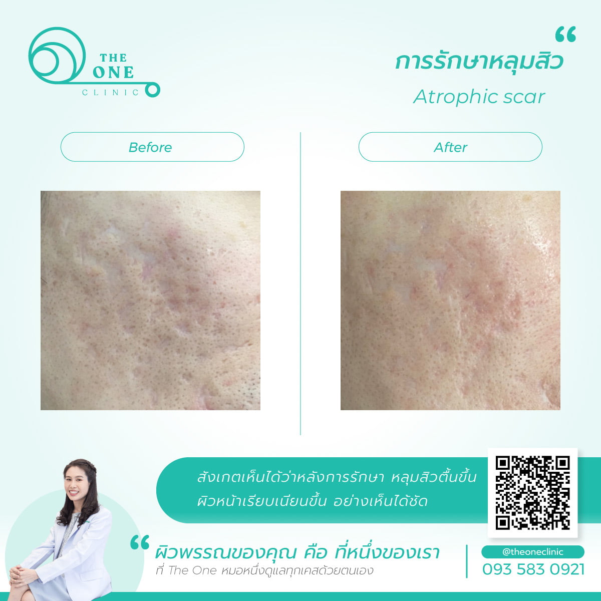 รีวิวรักษาหลุมสิว