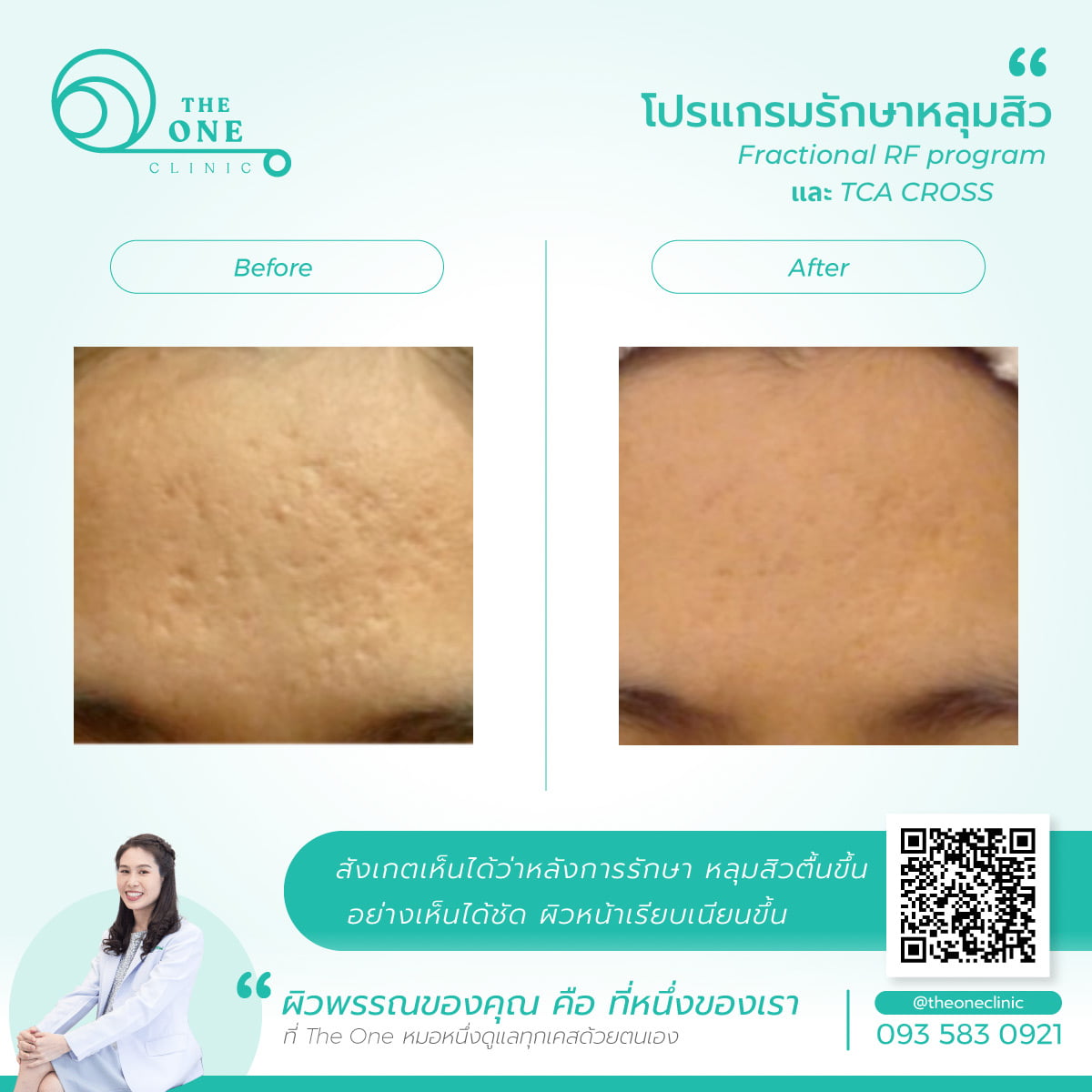 รีวิวโปรแกรมรักษาหลุมสิว