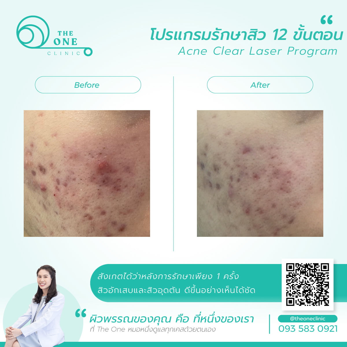 รีวิวรักษาสิวอักเสบสิวอุดตัน