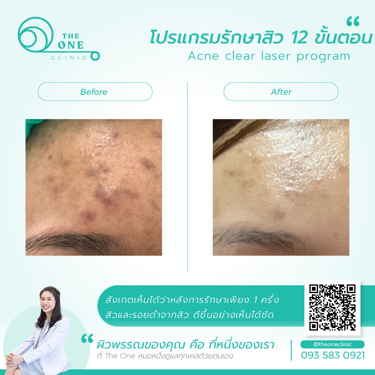 รีวิวรักษาสิวและรอยสิว