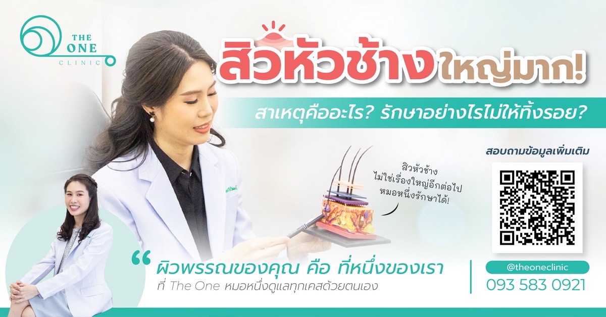 สิวหัวช้าง สาเหตุคืออะไร รักษาอย่างไร