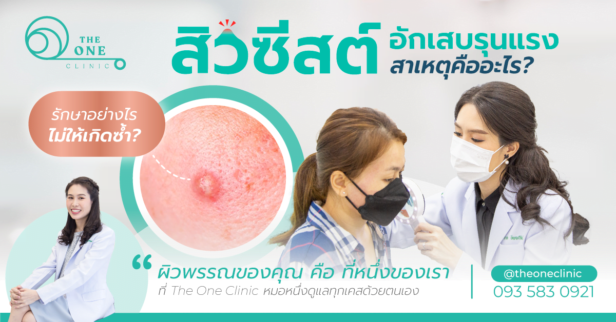 สิวซีสต์เกิดจากอะไร รักษาอย่างไร