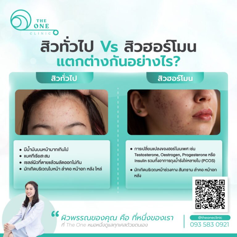 สิวทั่วไป กับ สิวฮอร์โมนต่างกันอย่างไร