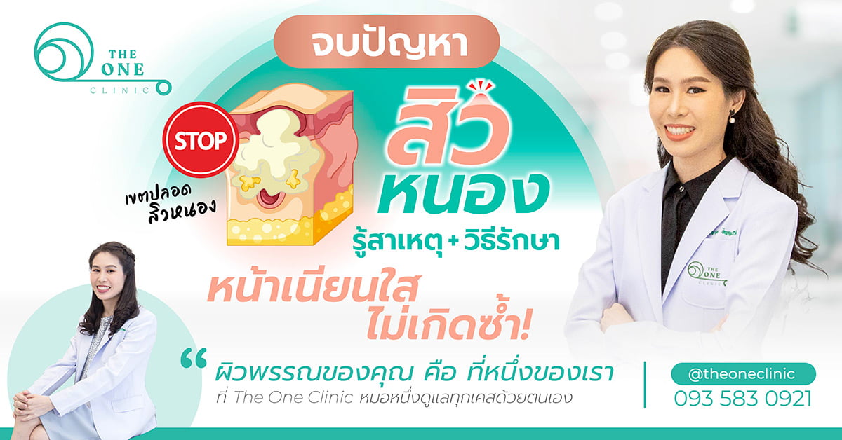 รู้สาเหตุและวิธีรักษาสิวหนอง
