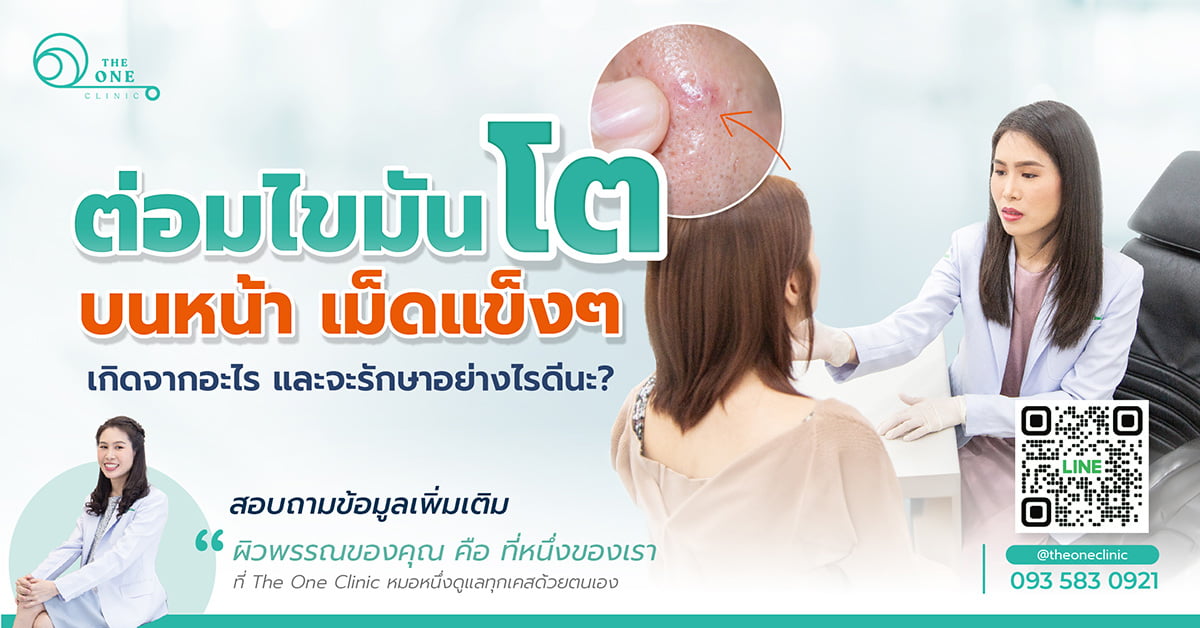 ต่อมไขมันโตบนหน้า