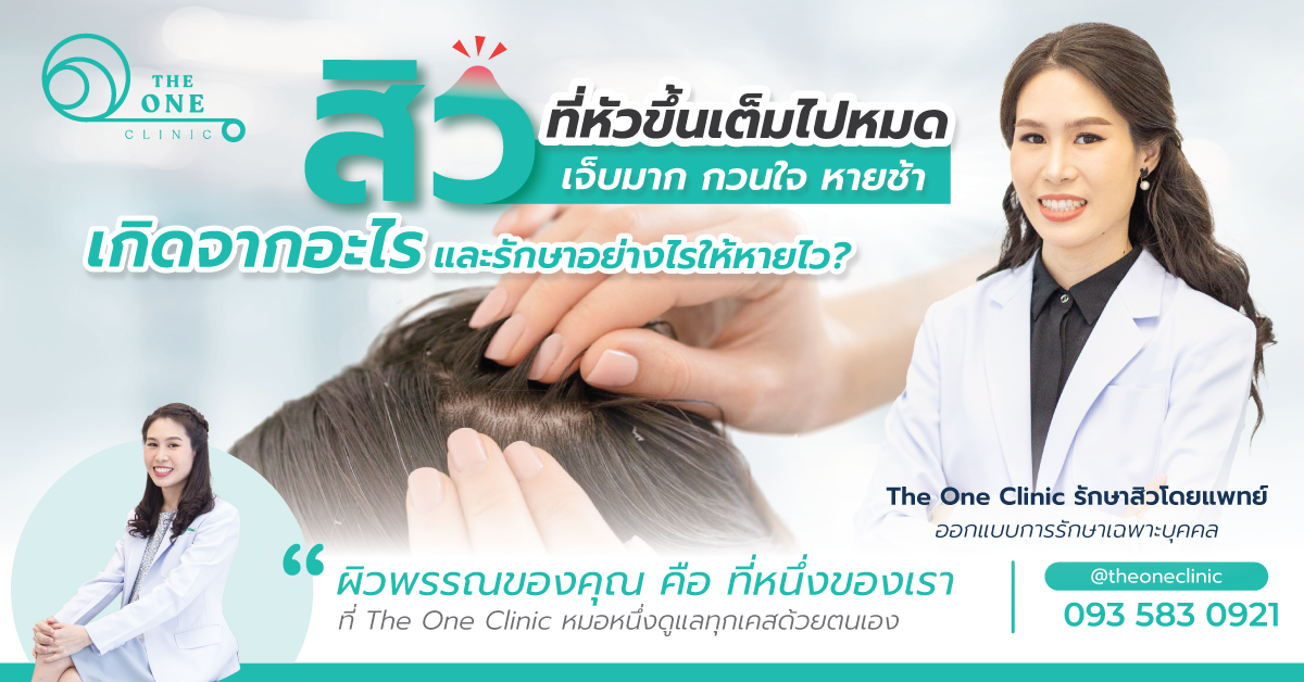 สิวที่หัว