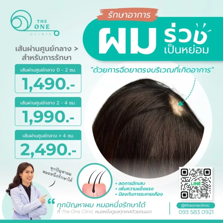 รักษาผมร่วงเป็นหย่อม