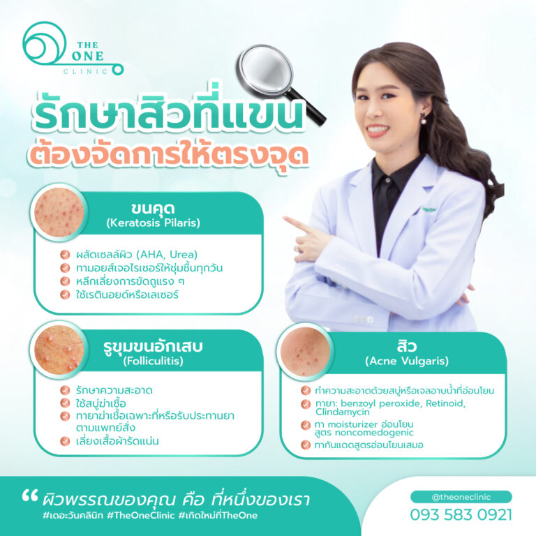 รักษาสิวที่แขน