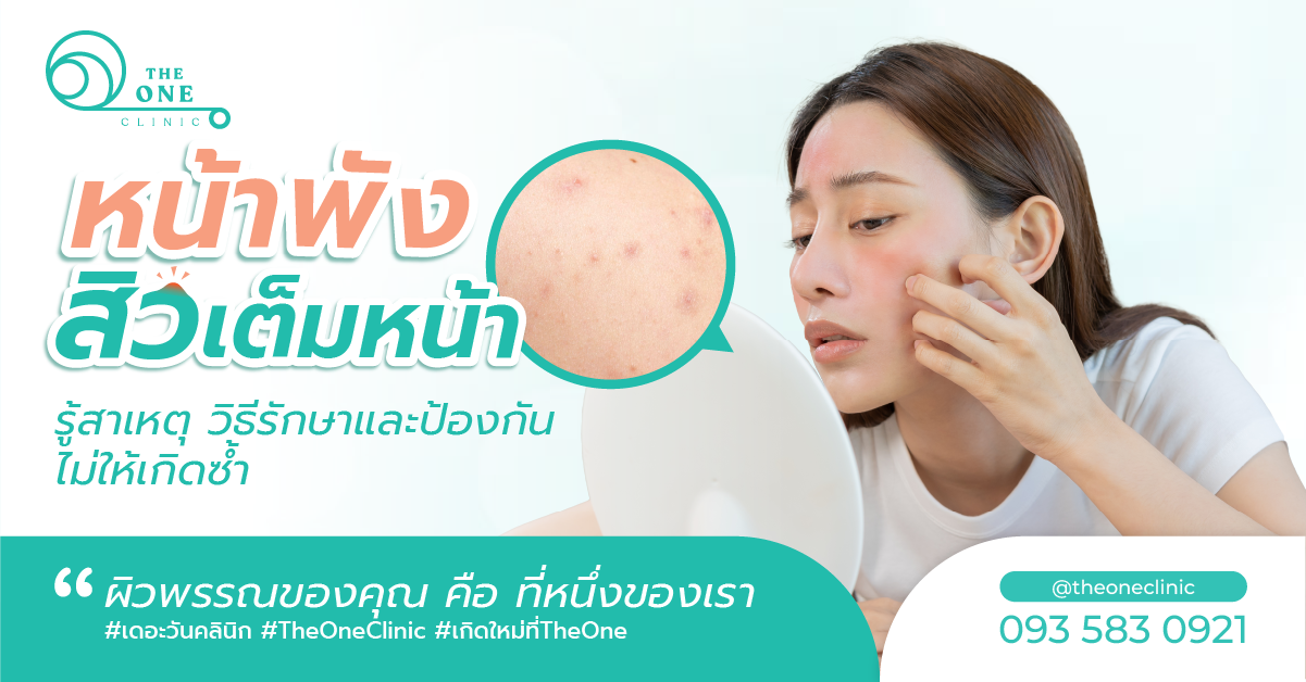 หน้าพัง สิวเห่อ