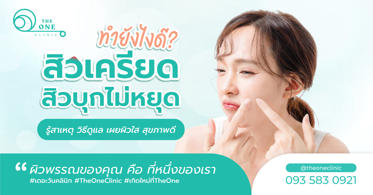 สิวเครียด