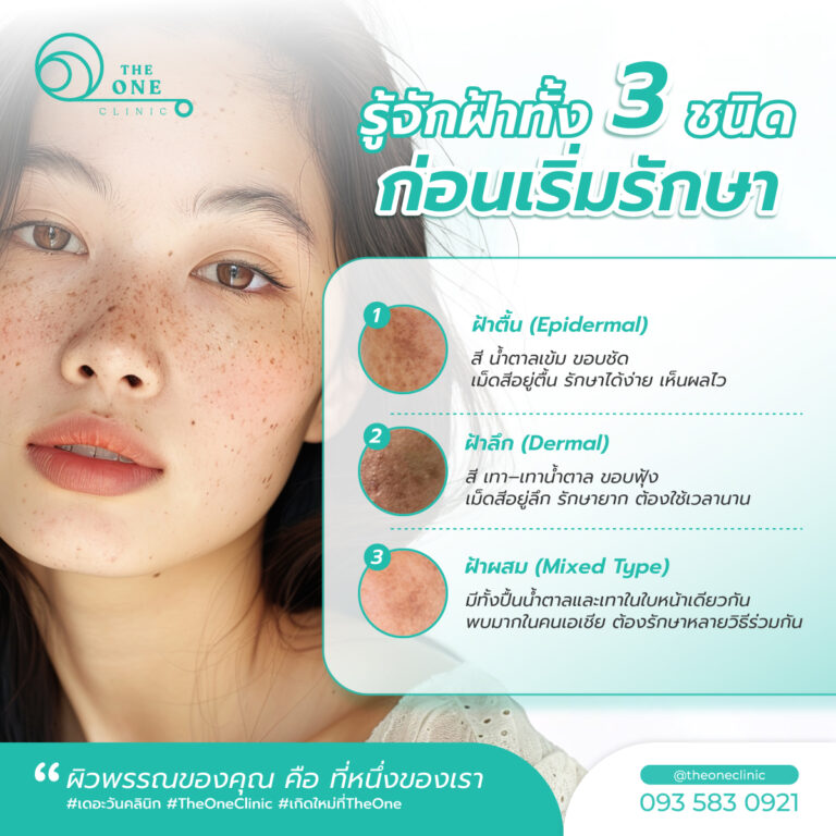 หน้าเป็นฝ้า ประเภท