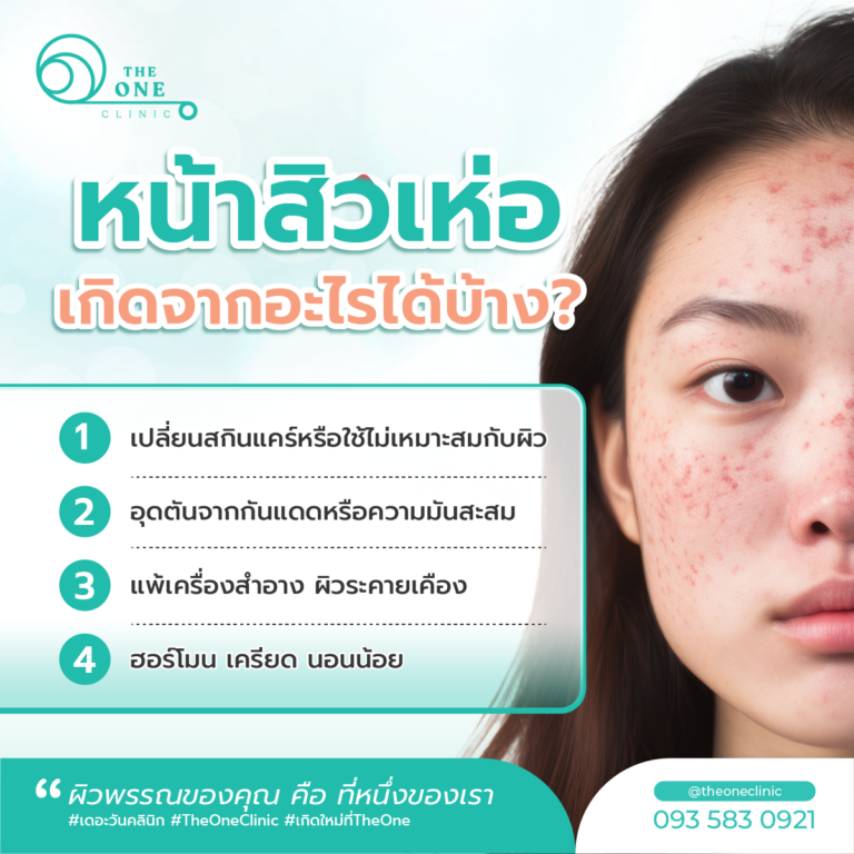 หน้าสิวเห่อ เกิดจากอะไร