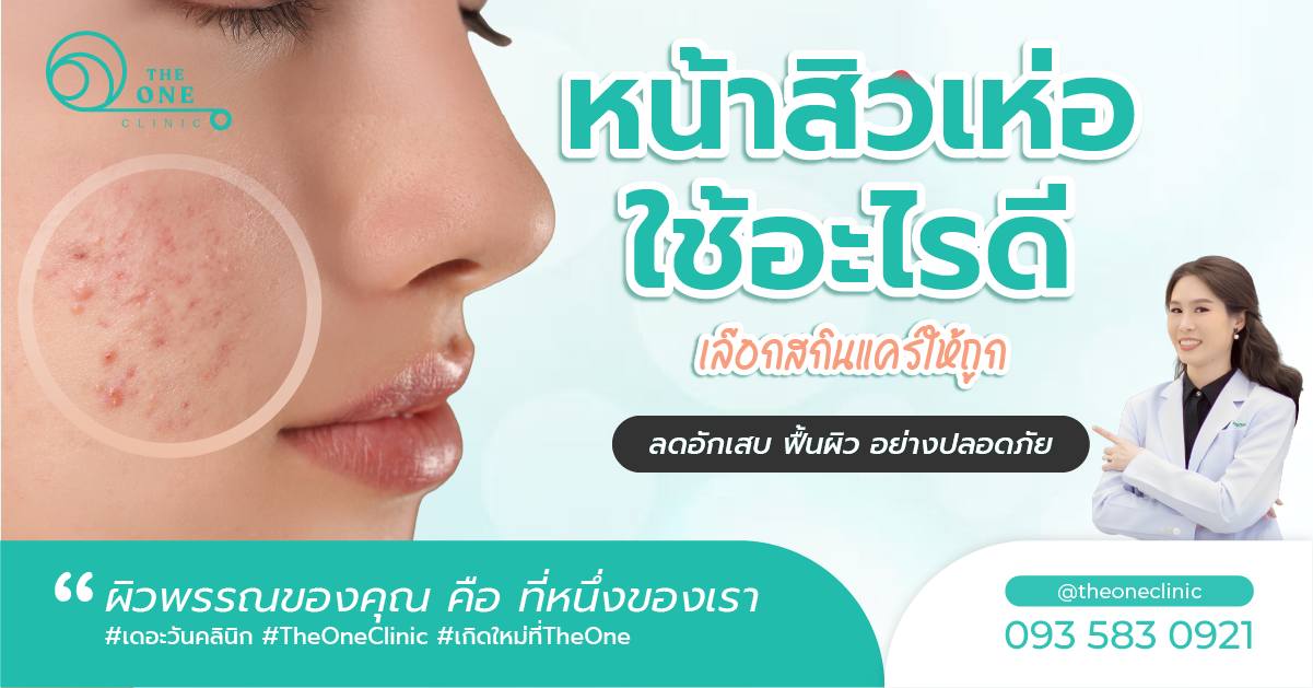 หน้าสิวเห่อ ใช้อะไรดี