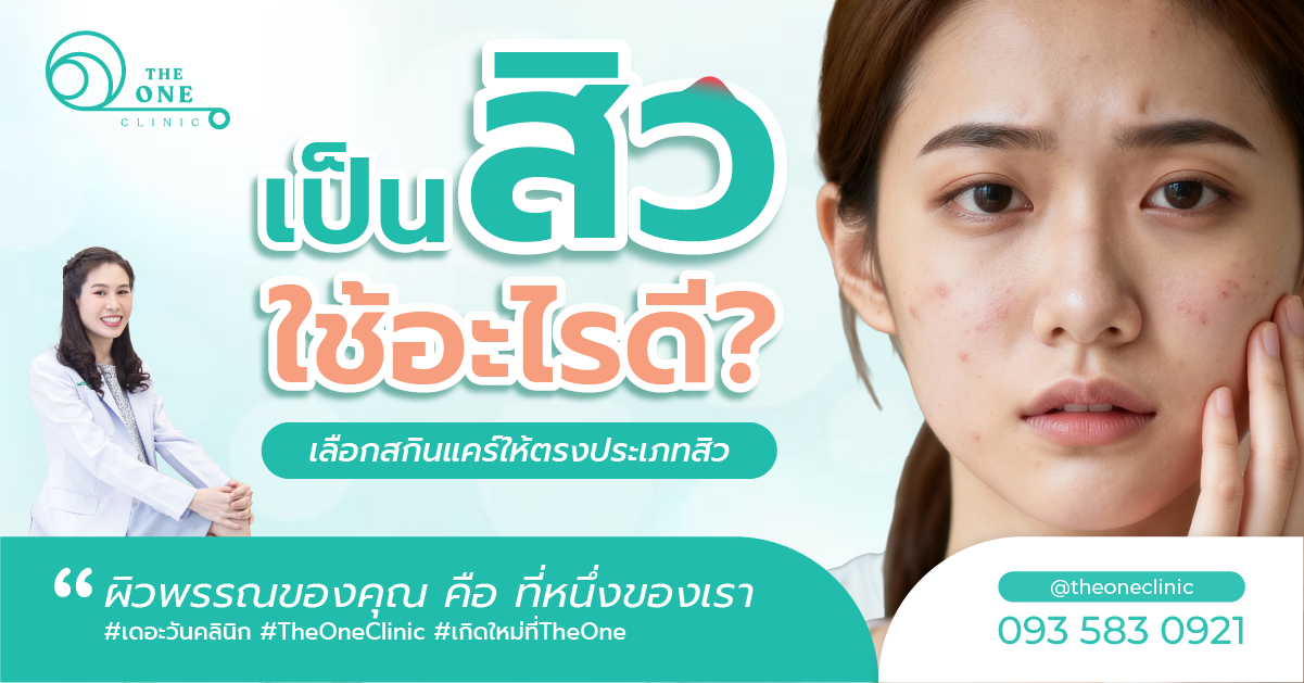 เป็นสิวใช้อะไรดี