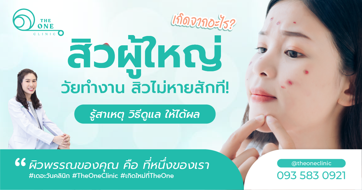 สิวผู้ใหญ่