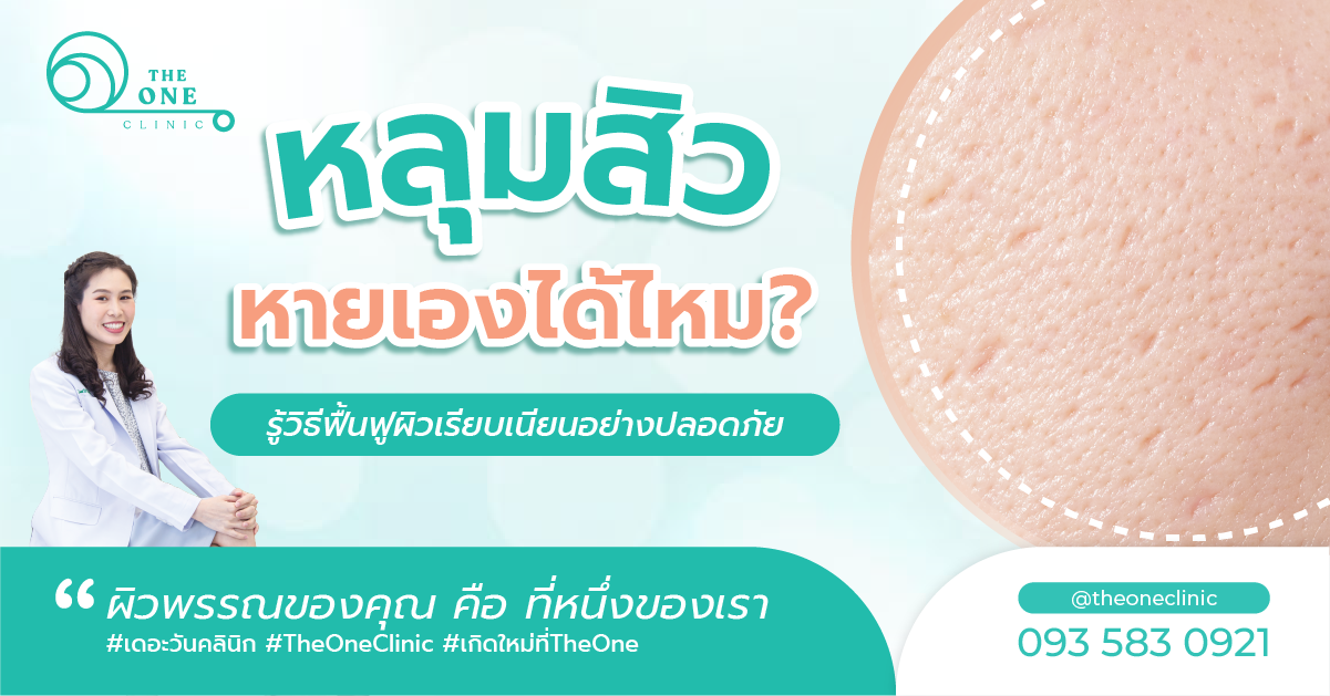 หลุมสิวหายเองได้ไหม